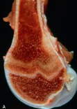 <p>Name this pathology and what causes it? Explain the pathogenesis. Describe the histology.</p>