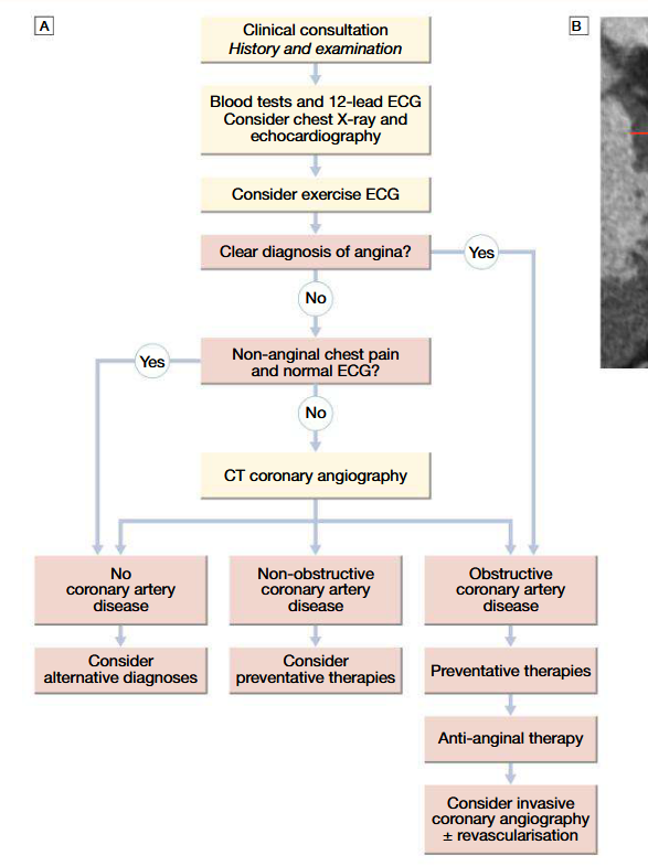 <ul><li><p>Stress-testing and non-invasive imaging to confirm diagnosis</p></li><li><p>Exercise ECG using standard treadmill or bicycle ergometer protocol, while monitorring pulse, BP and general condition: planar or downslope ST segment depression of 1 mm or more indicatice os ischaemia. Up-sloping ST depression less specific (may give false +ve wtih digoxin therapy, LVH, bundle branch block, etc)</p></li><li><p>CT coronary angiography: clarifies diagnosis and guides therapy (as well as invasive cardiac catheterisation); gives info about extent and nature of CAD (performed when coronary artery bypass graft surgery or percutaneous coronary intervention is being considered)</p></li><li><p>Known CAD patients: myocardial perfusion scanning or stress echo is indicated (perfusion defect at rest and not at stress = reversible MI, whilst perfusion defect in both phases = previous MI)</p></li></ul><p></p>