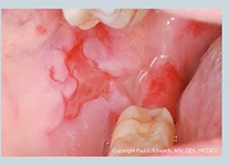 <p>what causes yellow bullae/blistering in the mouth?</p>