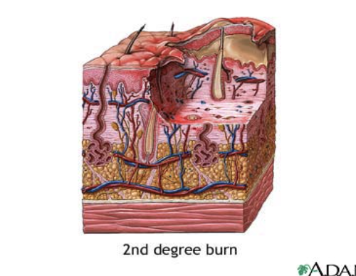 <ul><li><p>Involves the epidermis and dermis</p></li><li><p>Pain, redness, swelling and blistering</p></li><li><p>Should treat any 2nd degree burn that affects 1% or more of the body surface</p></li><li><p>Shock is likely to develop if injuries affect more 9% of body surface</p></li><li><p>Can be life-threatening</p></li></ul>