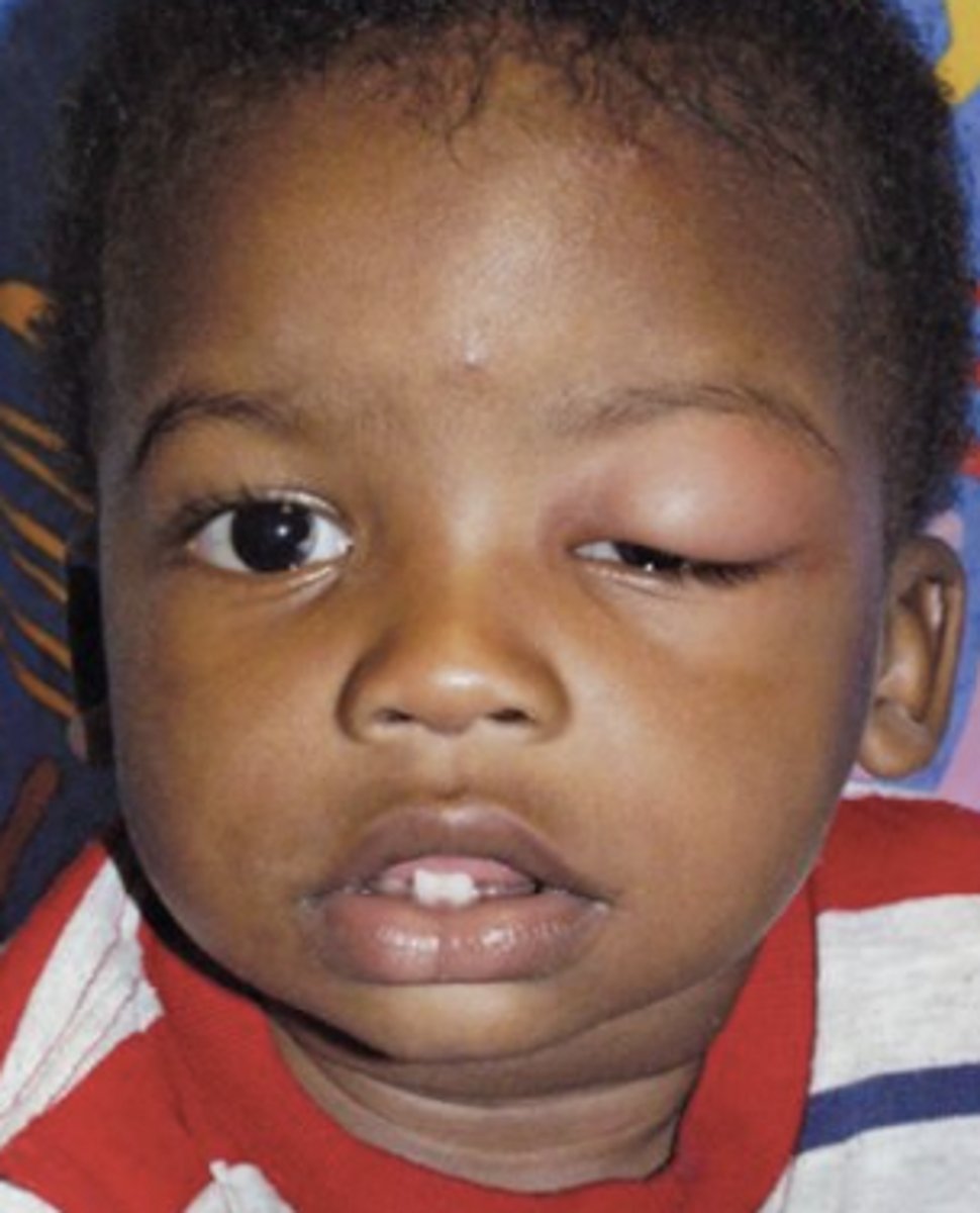 <p>More common in children, unilateral eyelid swelling, erythema, and pain, with the eyeball remaining unaffected.</p>