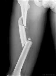 free floating piece of bone between well-defined fracture lines
