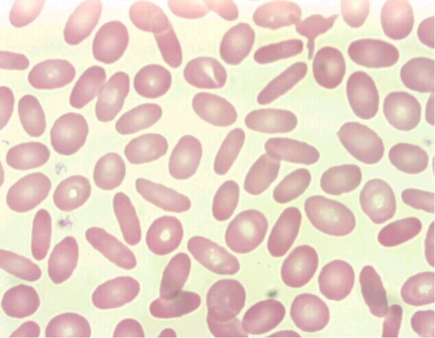 <p><u>oval, egg-shaped</u>, or elongated shape cells</p><p>may be normocytic or macrocytic and normochromic or hypochromic</p>