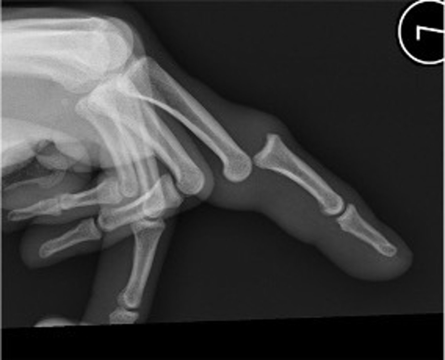 <p>Displacement of a bone that is no longer in contact with its normal articulation</p>