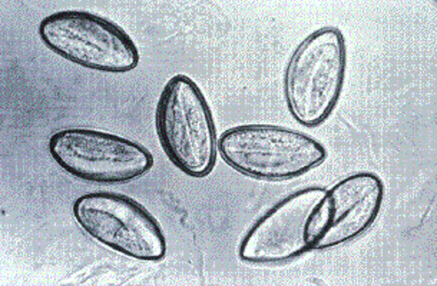 <p>b.Enterobius vermicularis.</p><p>Enterobius vermicularis (pinworm) is a worldwide parasite commonly detected in children. Key risk factors for this infection are inadequate personal and/or community hygiene. The cellophane tape preparation is routinely used for detection of suspected pinworm infections. This procedure involves swabbing the child’s perianal area with a tongue blade covered with cellophane tape (sticky side out). The egg is oval, colorless, and slightly flattened on one side. It measures approximately 50 to 60 μm by 20 to 30 μm.</p>