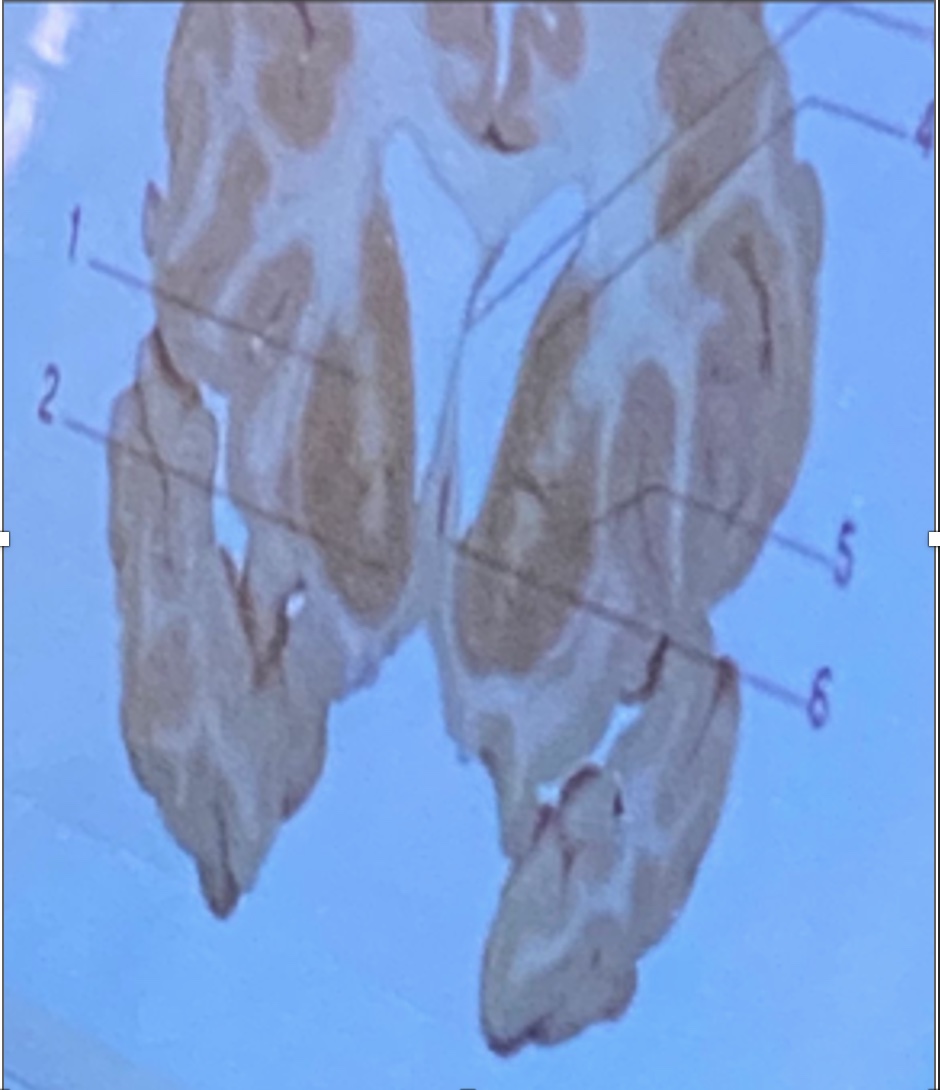 <p>Septum pellucidum</p><p>Putamen</p><p>Internal capsule</p><p>Nucleus accumbent</p><p>Caudate nucleus</p>