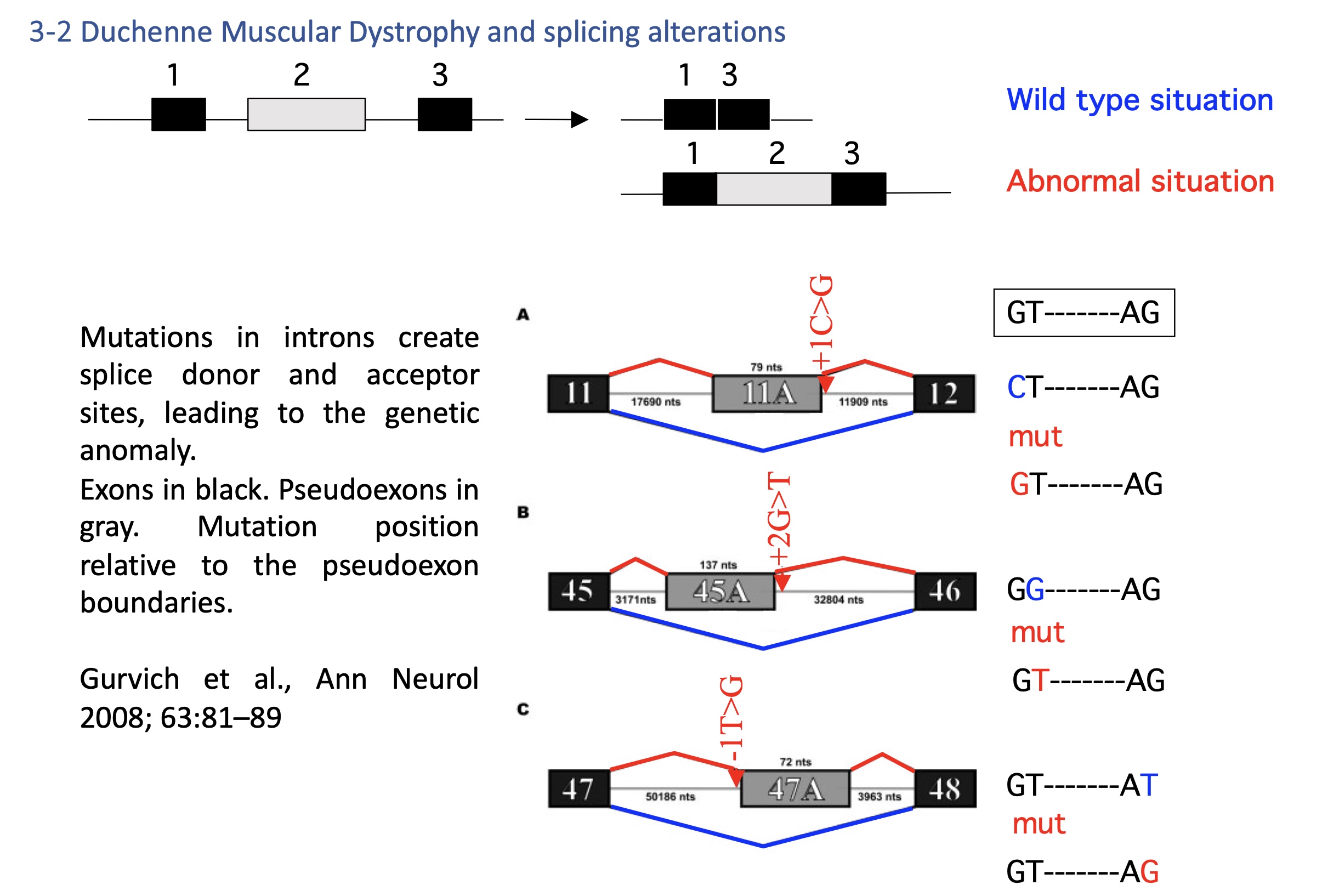 <ul><li><p>Mutations create <strong>cryptic splice sites</strong> in introns → inclusion of pseudoexons → nonfunctional dystrophin.</p></li><li><p>Therapeutic approach: <strong>antisense oligonucleotides</strong> to block aberrant sites and restore the reading frame</p></li></ul><p></p>