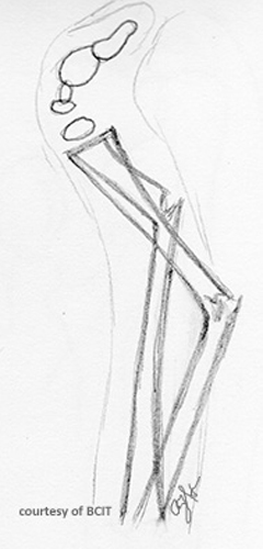 <p>Greenstick fracture.</p>