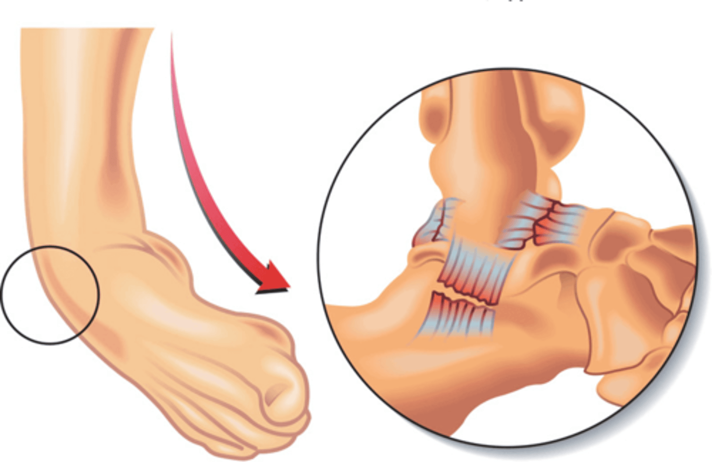 <p>(zie ook enkeldistorsie)</p><p>- overrekking/partiële scheur van vezels van de ligamenten a/d buitenzijde van de voet (=gekoppelde suspinatie + adductie van de voet in plantaire flexie + exorotatie onderbeen =&gt; krachten die ontstaan resulteren in verhoogde spanning laterale enkelgewrichten =&gt; als spanning rekbaarheid overschrijdt : ligamentaire schade ( vaak anterieur talofibulair ligament (voorste ligament)</p><p>- leidt tot tijdelijke sportstop</p><p>- tot 70% ontwikkelt residuele (blijvende) symptomen zoals pijn, zwelling, instabiliteit, zwakte... = chronische enkelinstabiliteit</p>