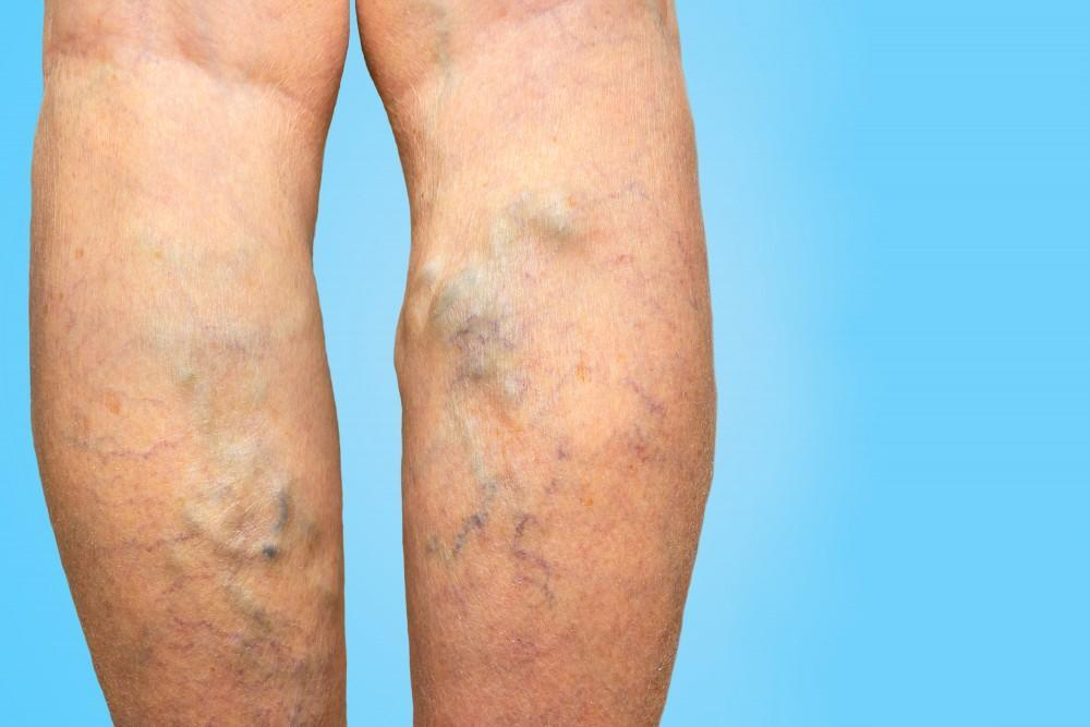 <p>Varicose veins</p>