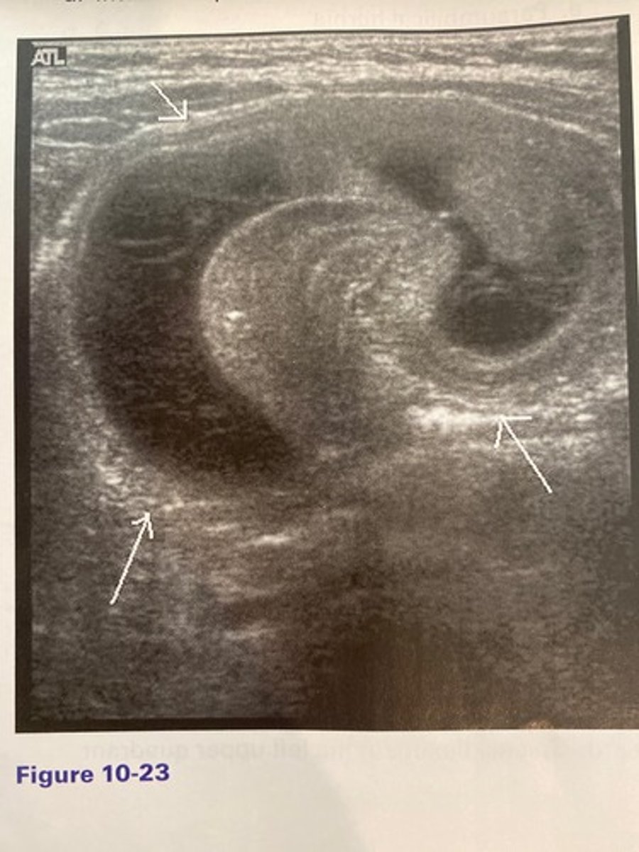 <p>The finding in Figure 10-23 was discovered in the right lower quadrant of an 18-month-old patient with a history of intermittent, severe abdominal pain, and vomiting. What is the most likely diagnosis?</p><p>a. Appendicitis</p><p>b. Colitis</p><p>c. Mechanical obstruction</p><p>d. Intussusception</p>