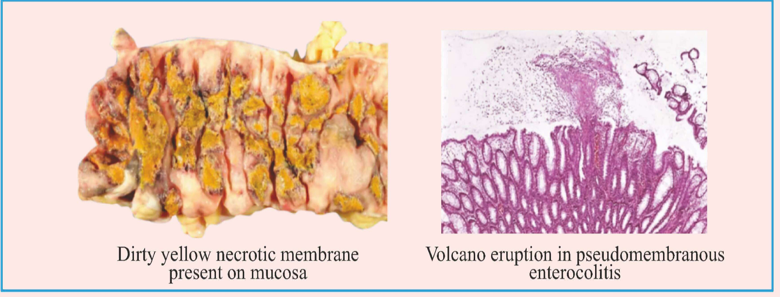 <ul><li><p>Toxin A &amp; B entering the system → attack the GTP binding proteins (Rho, Rac, CDC 42) - damage to actin cytoskeletal → cell death.</p></li><li><p>Toxins will stimulate ILS production → neutrophils recruitment → form dirty yellow necrotic membrane present on mucosa.</p></li><li><p>The dead cells will burst out like a volcano eruption (in microscopic vision)</p></li></ul><p></p>