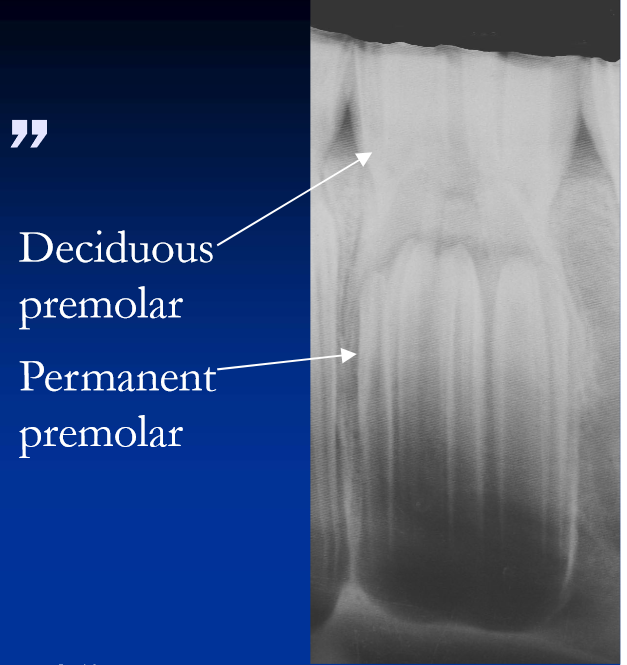 <ul><li><p>Deciduous premolars being shed as permanents erupt </p></li><li><p>these are usually shed naturally; however </p></li><li><p>permanent P3 and P4 erupt at 3 and 4 years and are prone to crowding with retention/delayed shedding of caps </p><ul><li><p>erupt between permanent P2 and M1 which are already in place </p></li></ul></li></ul><p></p>