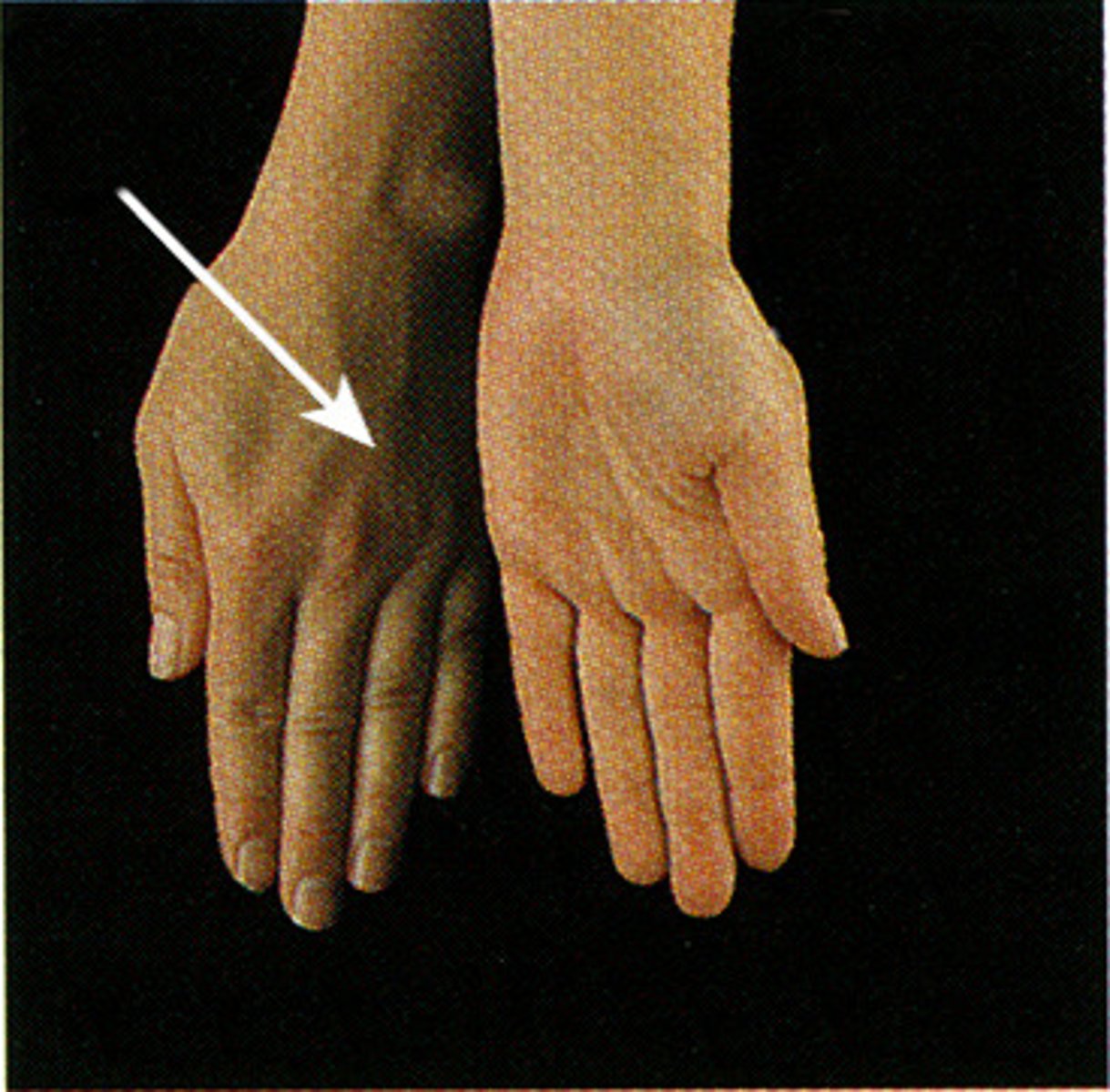 <p>turning the hand so that the palm faces downward or backward.</p>