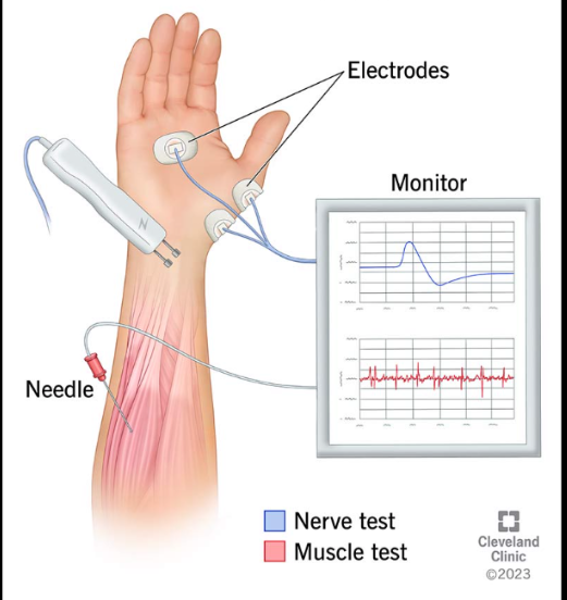 <p>It evaluates muscle action potentials. EMG is used to diagnose muscle disease and to evaluate patient response to therapy</p>