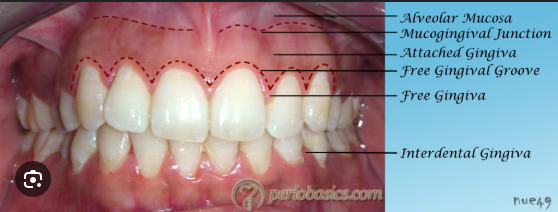 <p>shallow linear groove, demarcating the free gingiva from attached</p>