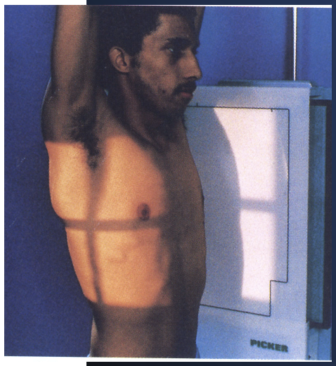 <p>lateral chest</p><ul><li><p>72 SID</p></li><li><p>hands above head </p></li><li><p>affected side towards IR </p></li><li><p>double inhalation </p></li><li><p>CR middle below scapula </p></li></ul><p></p>