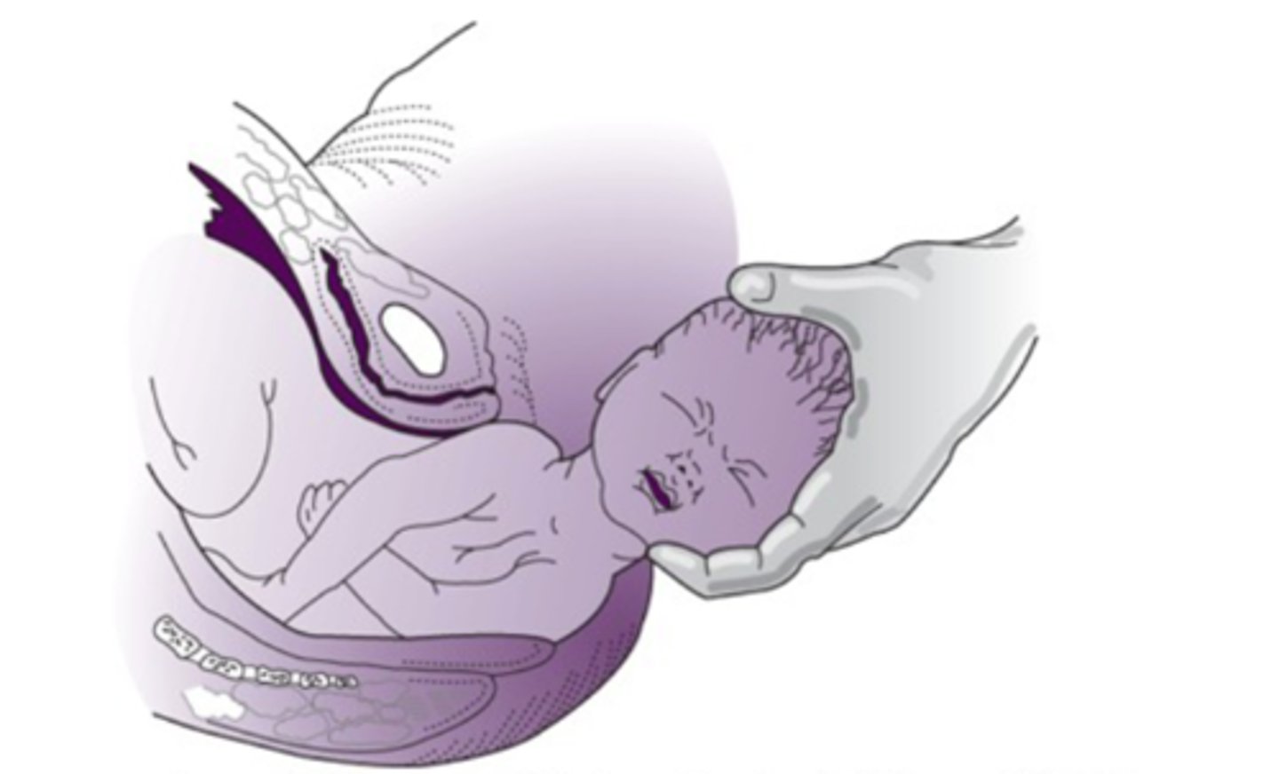 <p>-delivery of the entire fetus</p>