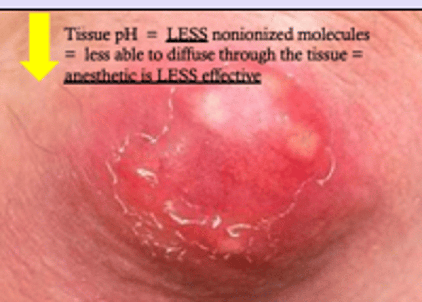<p>Metabolic acidosis (lactic acid) occurring in tissue</p><p>- decreased pH keeps LA ionized</p><p>- preventing it's movement through tissue</p><p>**anesthetics work best at physiologic basic pH</p>