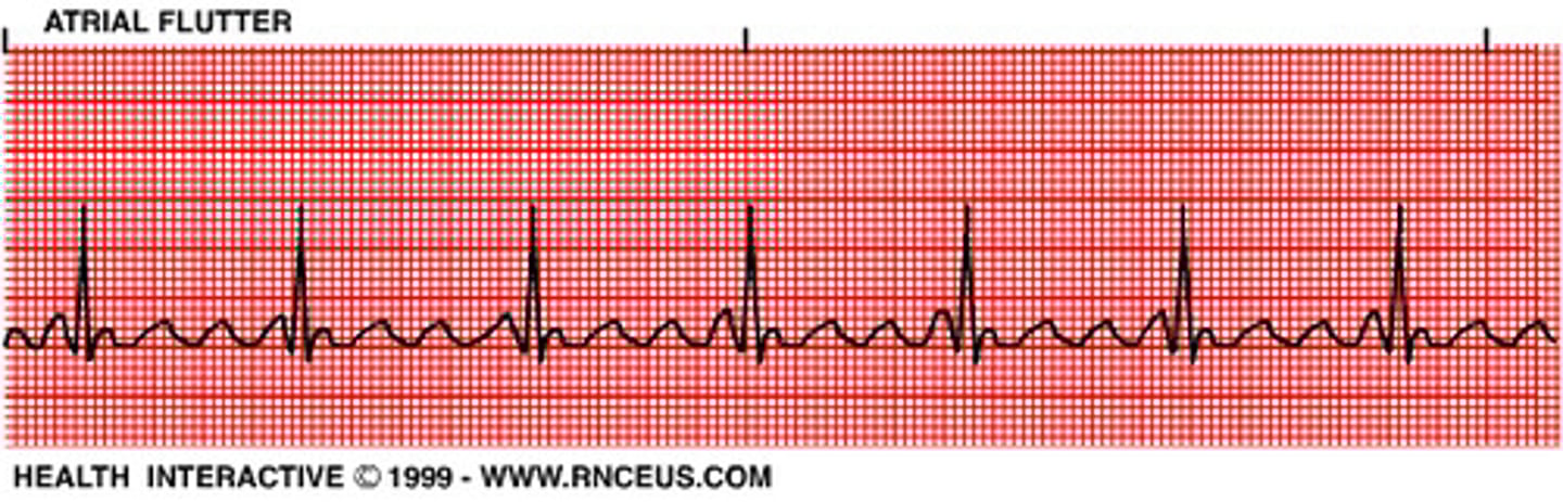<p>Atrial Flutter</p>