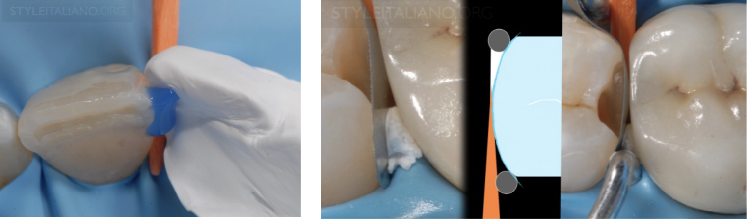 <ul><li><p>thin, non-sticky and chemically inert </p></li><li><p>smooth surface and very low friction w surface </p></li><li><p>resistant to water and etchant </p></li><li><p>soft, easy to manipulate and shape on/between surfaces </p></li><li><p>cheap and safe </p></li></ul><p></p>