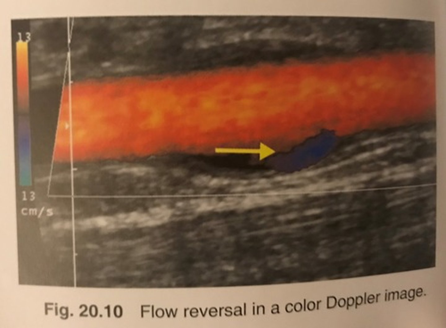 <p>flow reversal</p>
