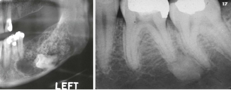 <p>A mix of dense tissue (e.g odontogenic lesions, fibro-osseous lesions)</p>