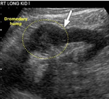 <p>Dromedary hump: Most commonly found in the left kidney&nbsp;</p>