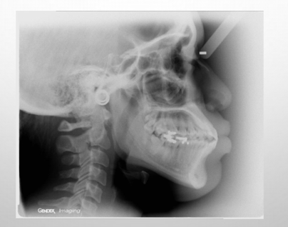 <p>-present when the anterior teeth are anterior to the normal limits of the basal bone</p><p>-bimaxillary dentoalveolar protrusion: present when the anterior teeth of both jaws are anterior to the normal limits of the basal bone</p><p>-maxillary dentoalveolar protrusion: present when the anterior teeth of the maxilla are anterior to the normal limits of the basal bone</p><p>-mandibular dentoalveolar protrusion: present when the anterior teeth of the mandible are anterior to the normal limits of the basal bone</p>
