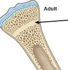 <p>occurs when epiphyseal plates have fused together after growth has stopped</p>