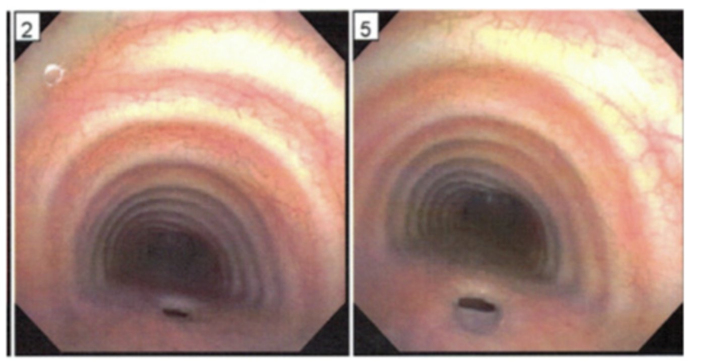 <p>tracheoesophageal (TE) prox. esophageal pouch with distal fistula to airway</p>