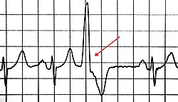 <p>Premature Ventricular Contraction</p><p>Treated by intravenous lidocaine or other antiarrhythmia drugs such as procainamide or propranolol if more than 6 PVCs per minute.</p>