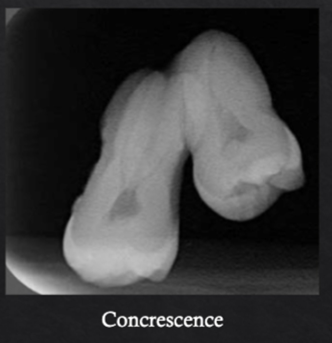 <p>Fusion of the cementum of two adjacent teeth</p>