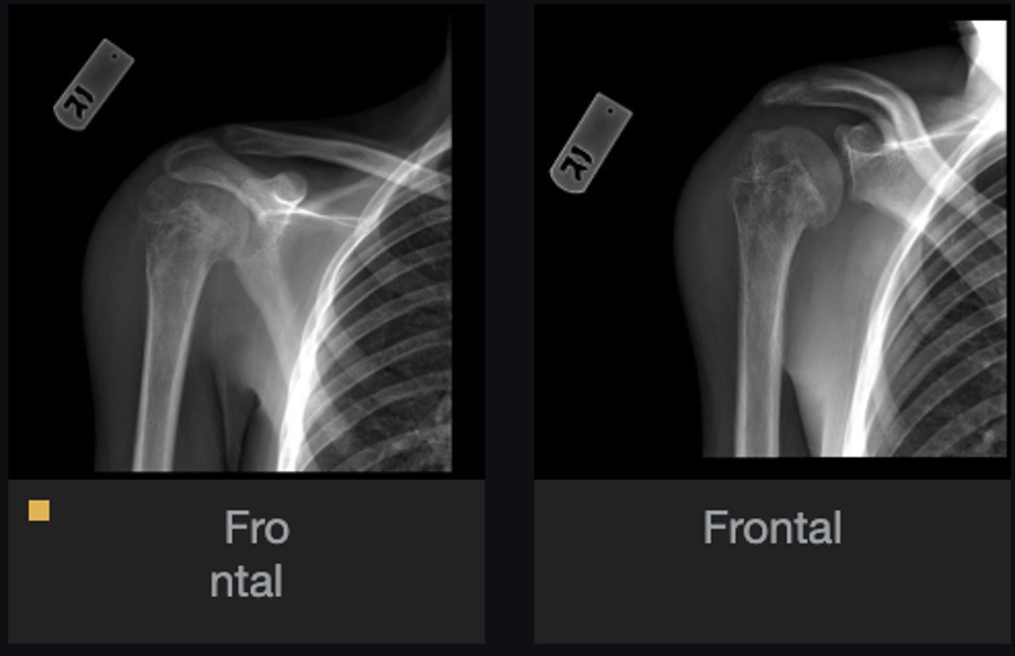<p>Bone</p>