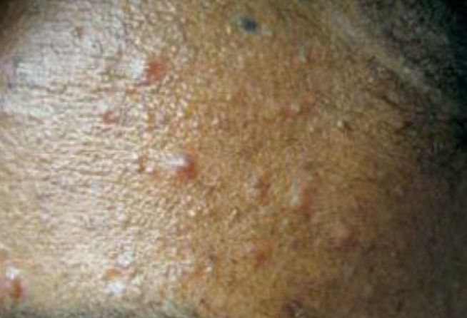 <p>what lesion is depicted</p>