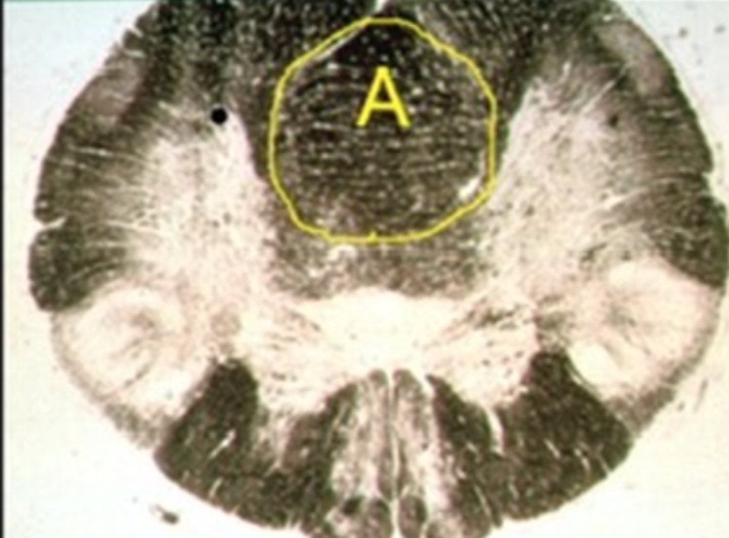 <p>Describe the signs/symptoms you will see if structure "A" is lesioned.</p>