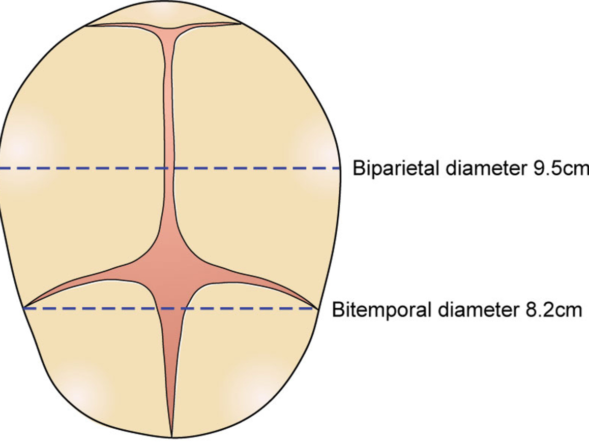 <ul><li><p>biparietal (8.5cm)</p></li><li><p>Bitemporal (8.2cm)</p></li></ul><p></p>