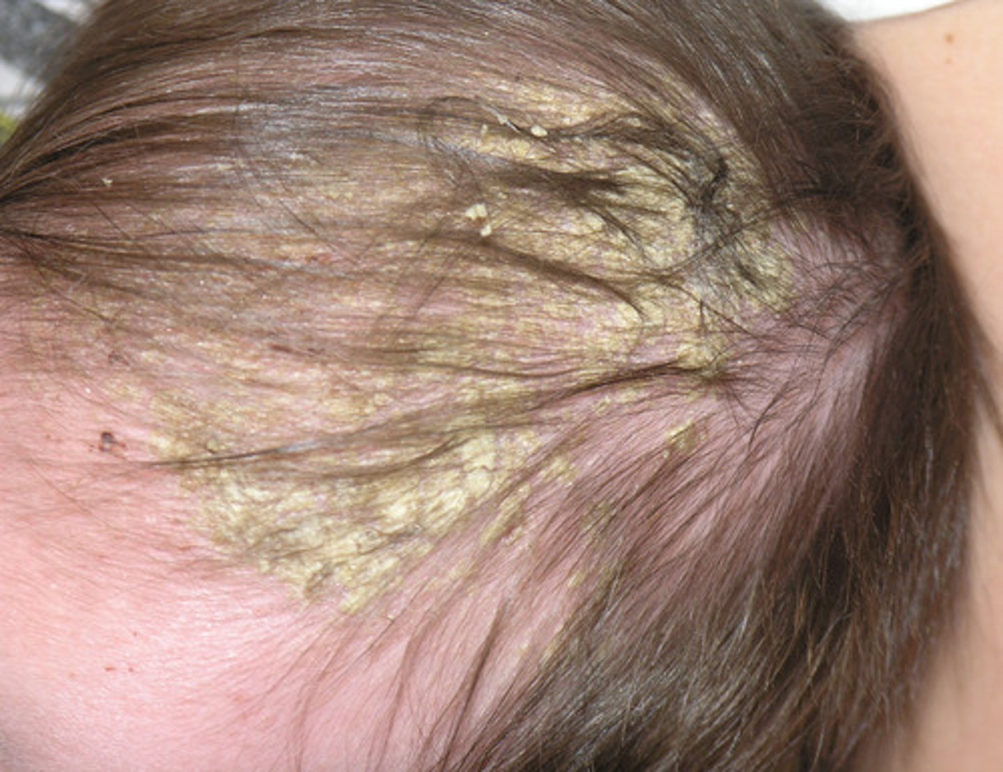 <p>Seborrheic Dermatitis</p>