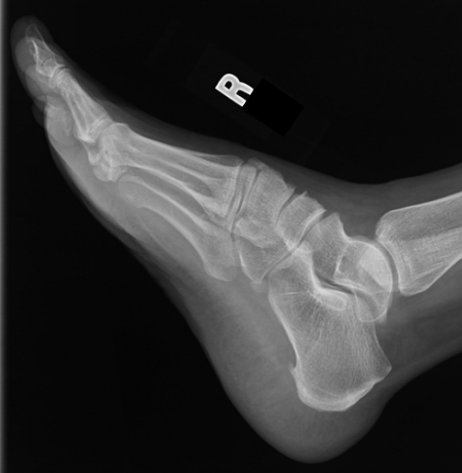 <p>Criteria is same as LAT Foot</p><ul><li><p>5MT free of SI from other MT due to natural inversion</p></li><li><p>prox/dist sep of talar domes due to natural inversion</p></li></ul><p></p>