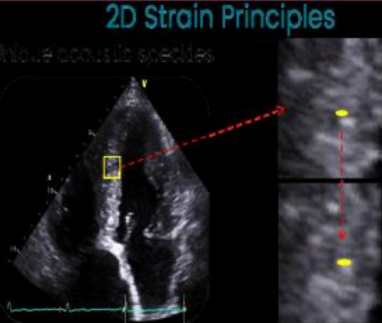 <p>The distances between the speckles are tracked frame to frame over the cardiac cycle and provides information about myocardial deformation.</p>