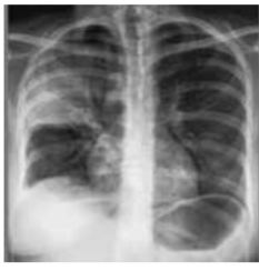 Right upper lobe consolidation