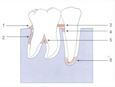 <p>3) over the alveolar bone, no osseous attachment</p>