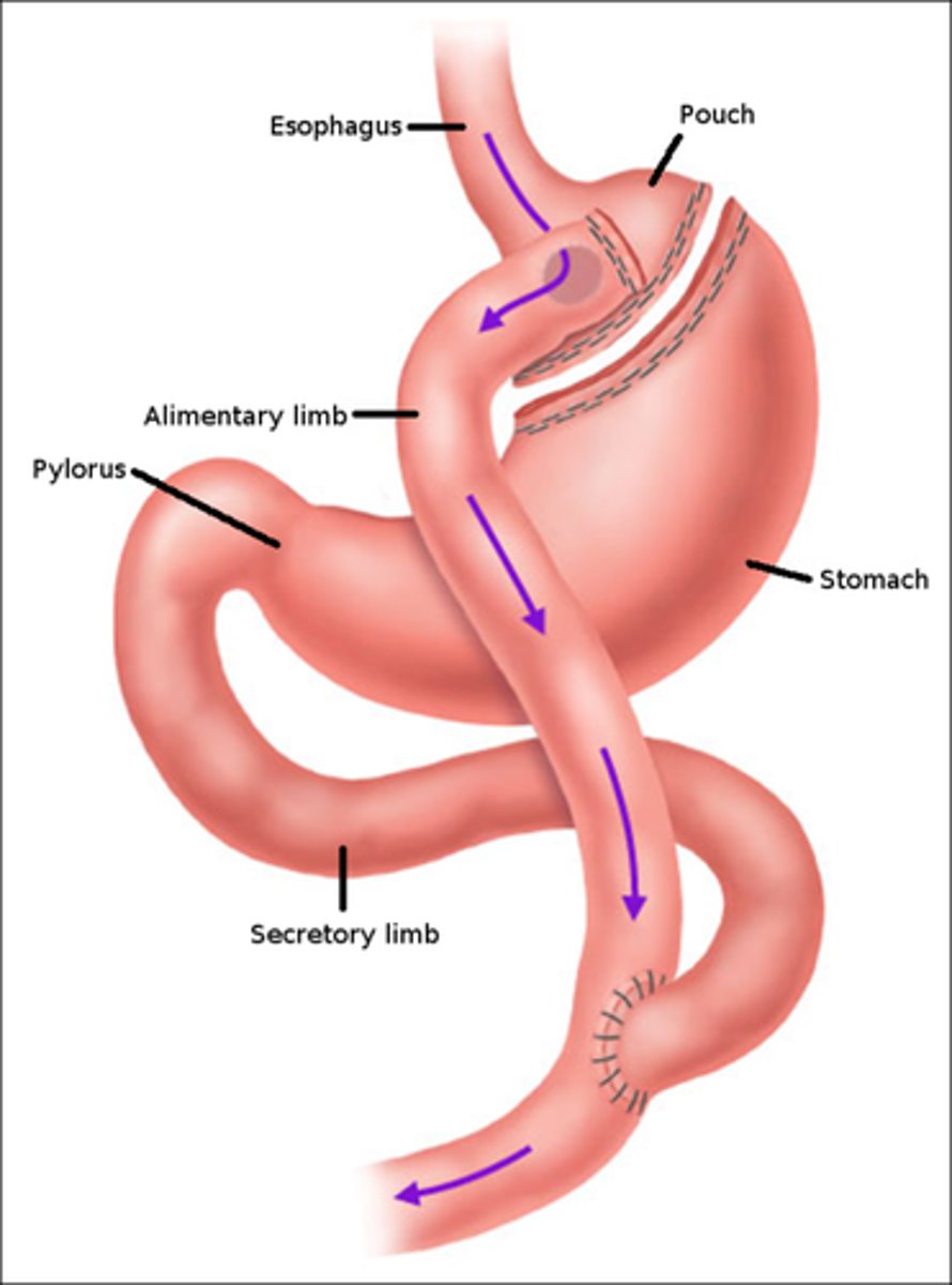 <p>- SI is divided and connected to early part of stomach (so most of stomach and SI is bypassed)</p><p>- this both restricts food intake and causes malabsorption</p><p>30-35% weight loss</p>