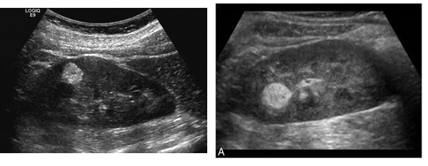 <p><span>Renal Angiomyolipoma</span></p>