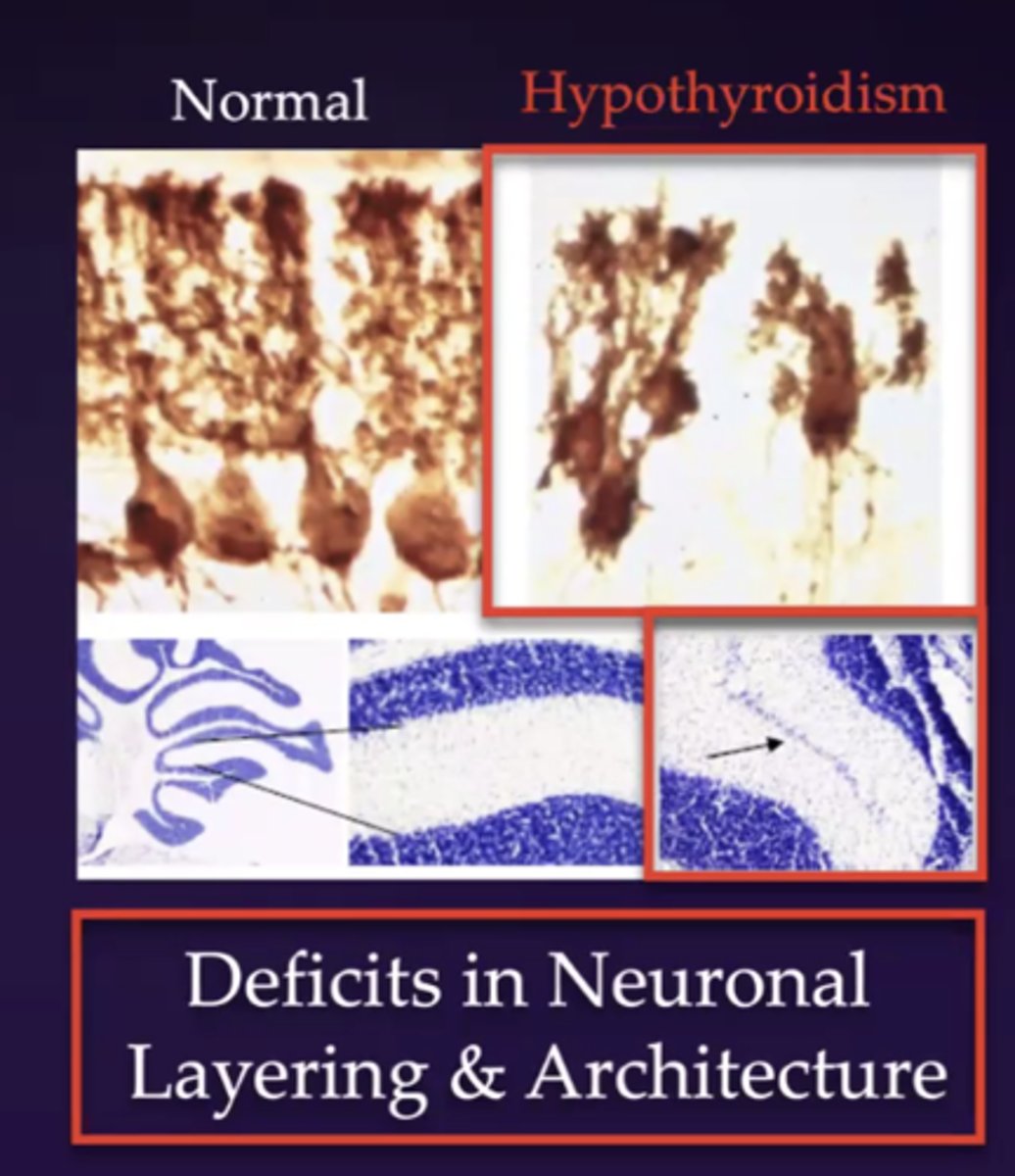 <p>deficits in neuronal layering and architecture</p>