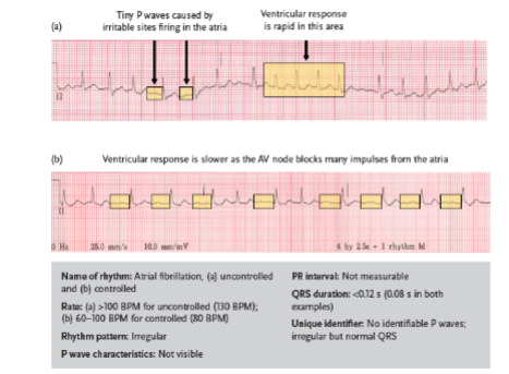 <p>a common dysrhythmia that occurs when multiple irritable sites fire in the atria; considered controlled if the ventricular rate is under 100 BPM and uncontrolled if the ventricular rate is above 100 BPM</p>