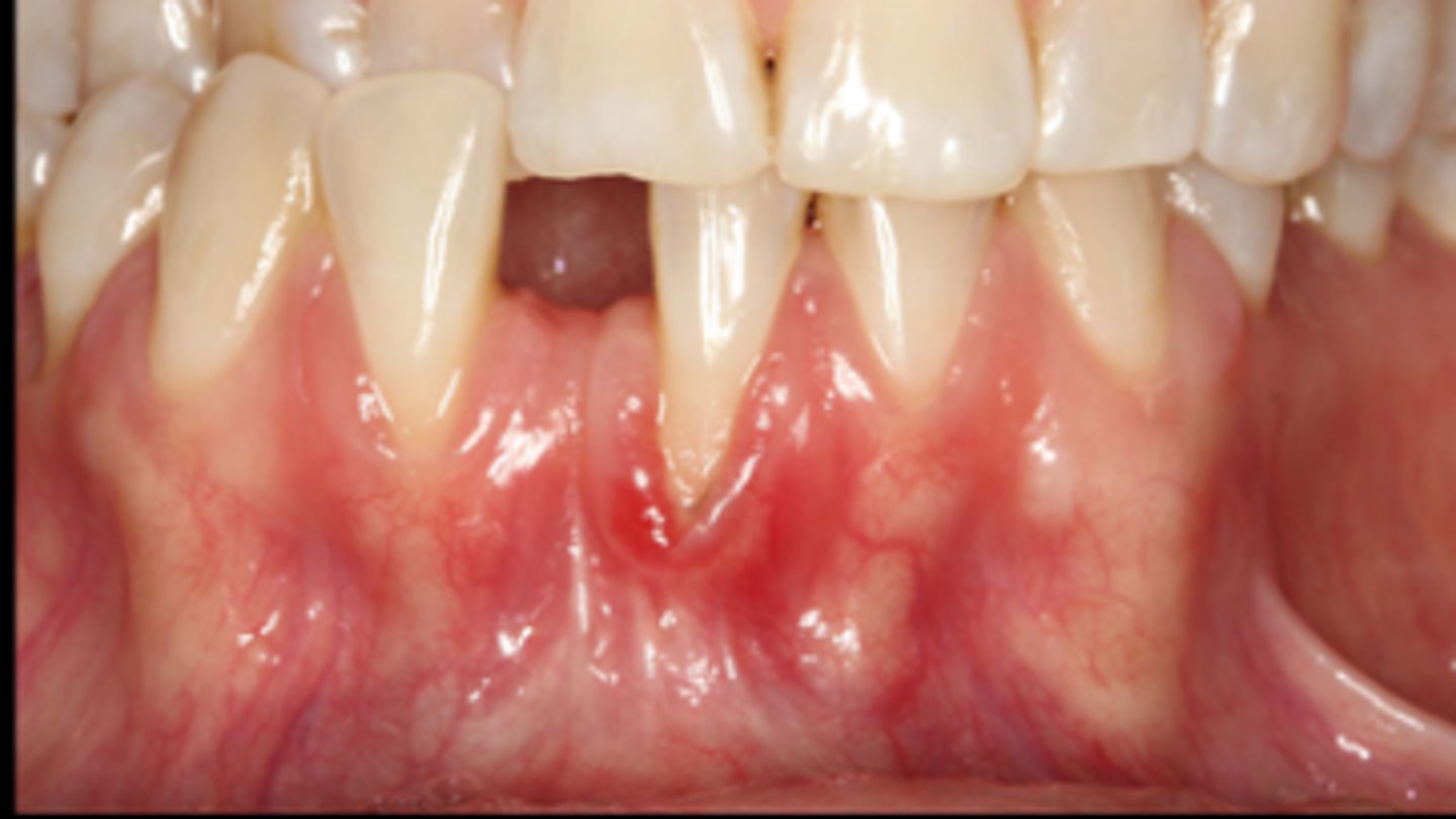 <p>Describe the teeth shape and gum type:</p><p>• ______ shaped teeth</p><p>• ____ gums</p><p>• significant because bacteria can go through this tissue easily</p>