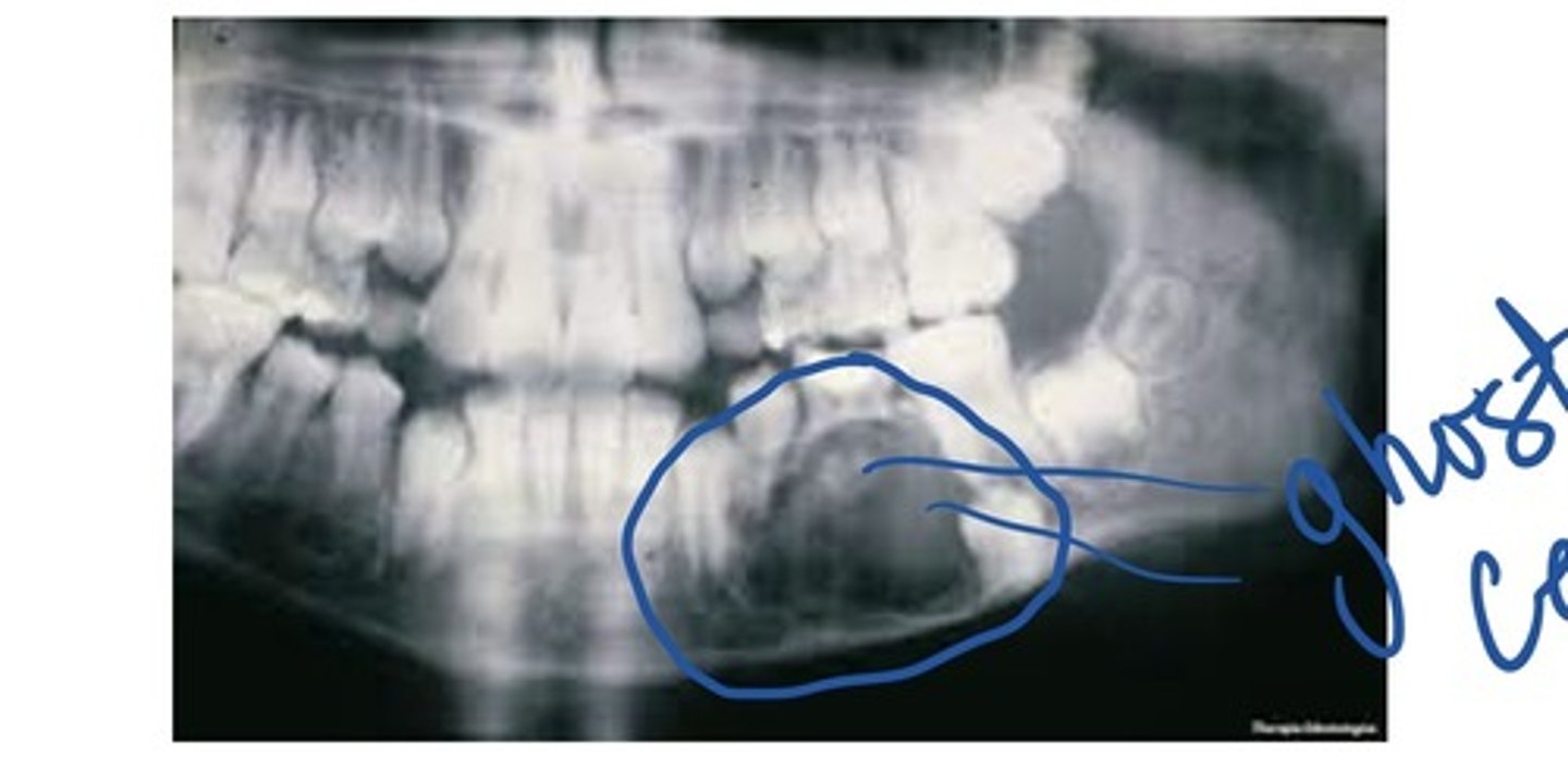 <p>A non aggressive, cystic lesion lined by odontogenic epithelium</p><p>Closely resembles an ameloblastoma</p><p>Characteristic feature called ghost cells</p>