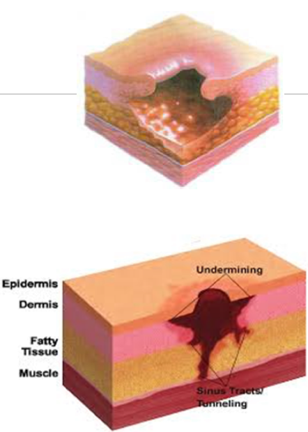 <p><strong>Full-thickness tissue loss</strong></p><ul><li><p>Subcutaneous tissue may be visible</p></li><li><p>Slough may be present but able to visualize wound bed</p></li><li><p>May include undermining and/or tunneling</p></li></ul><p></p>