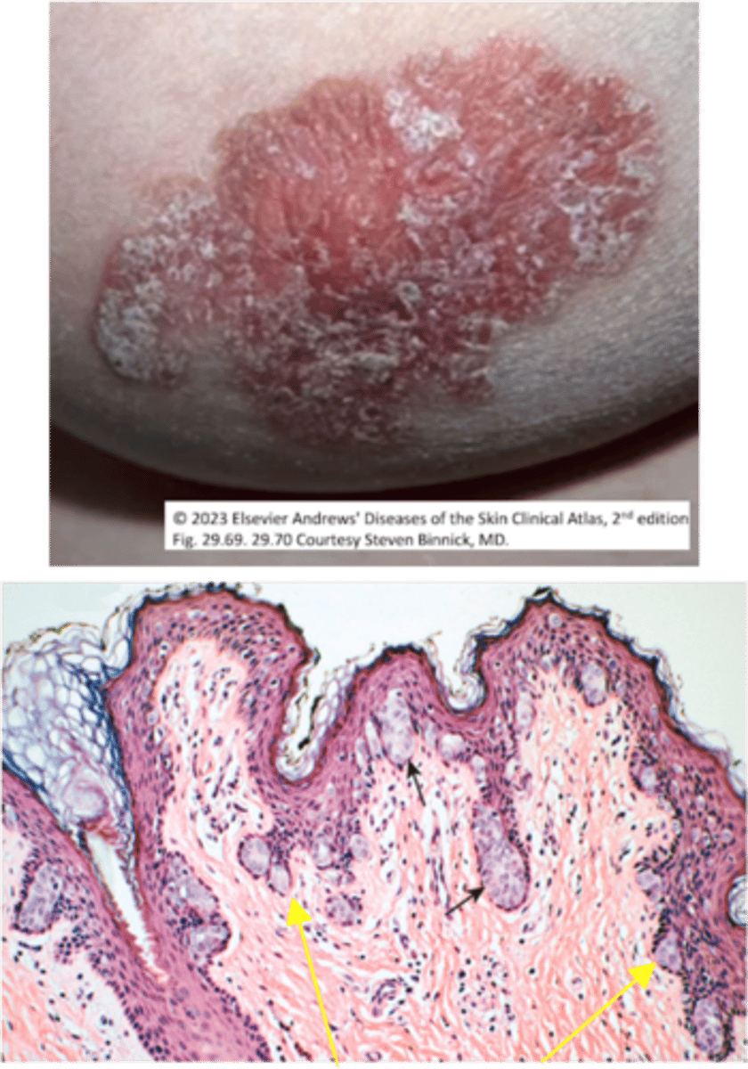 <p>Define Type of Breast Cancer:</p><p>Malignant proliferation of cells in ducts with no invasion of the basement membrane - extends up the lactiferous ducts to involve nipple skin</p><p>-Hx: Almost always associated with an underlying DCIS/invasive carcinoma</p><p>-Sx/PE: Eczematous/Erythematous change of nipple areolar skin</p><p>-Dx: Histo</p><p>&gt; Enlarged, polygonal epithelial cells with abundant pale cytoplasm, large nuclei</p><p>-Prog:</p><p>&gt; Risk of carcinoma in SAME breast</p><p>&gt; Best Predictors for Recurrence/Progression = Nuclear grade &amp; Necrosis</p>